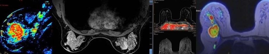 MRI piersi